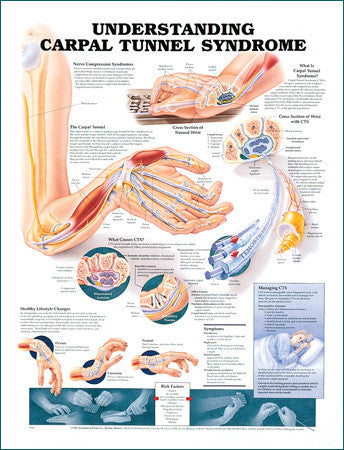 Understanding Carpal Tunnel Syndrome