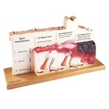 Burn pathologies model