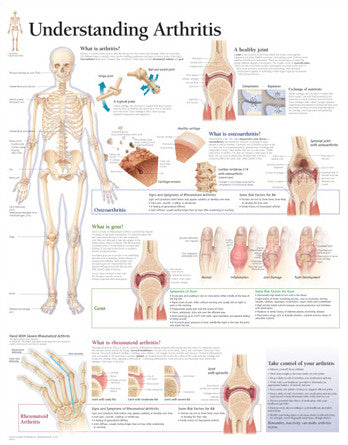 2152-08 Understanding Arthritis