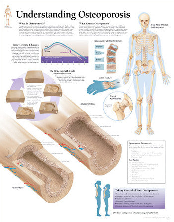 2153-08 Understanding Osteoporosis