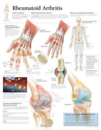 2155-08 Understanding Rheumatoid Arthritis