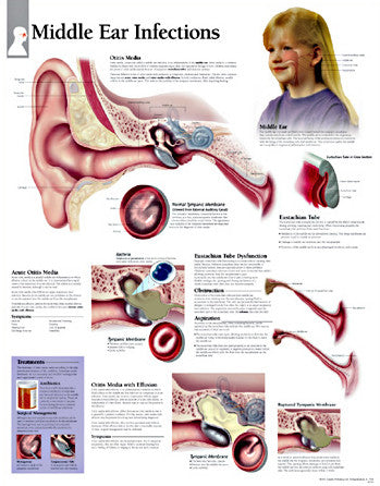 2215-08 Middle Ear Infections