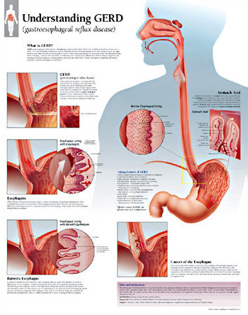 2550-08 Understanding GERD (gastroesophageal reflux disease)