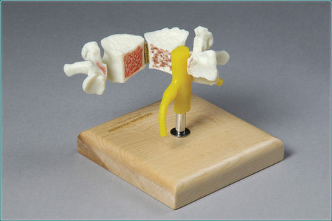 SA24 Vertebra showing Arthritis and Osteoporosis
